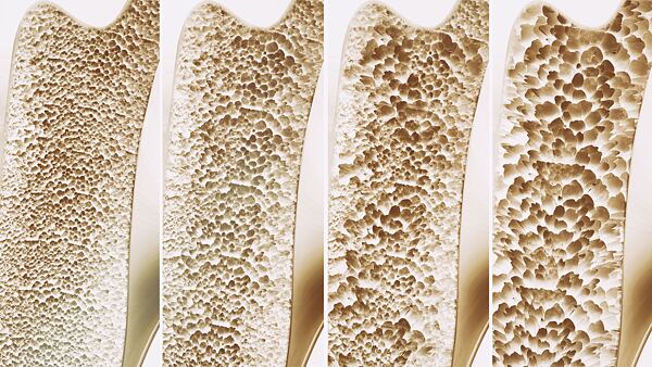 Osteoporóza a řídnutí kostí nedostatkem vápníku